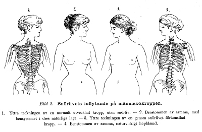 Illustration som visar hur inälverna i buken pressas samman av snörliv.