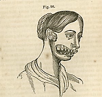 Illustration av kvinna med fosforskadad käke